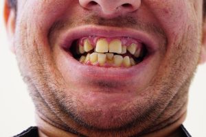 How to Fix Crooked Teeth Without Braces at Home