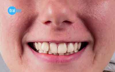 How to Fix Crooked Teeth Without Braces at Home